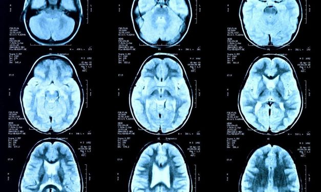Marinus Anti-Epileptic Drug Enters Third Phase of Clinical Trials